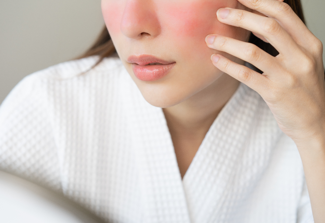 3 életmódbeli változtatás, amivel csökkentheted a rosacea tüneteit